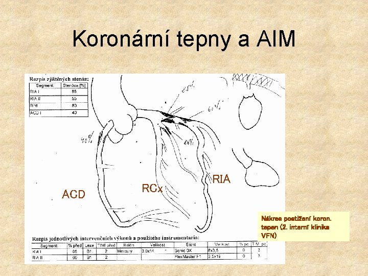 Koronární tepny a AIM ACD RCx RIA Nákres postižení koron. tepen (2. interní klinika