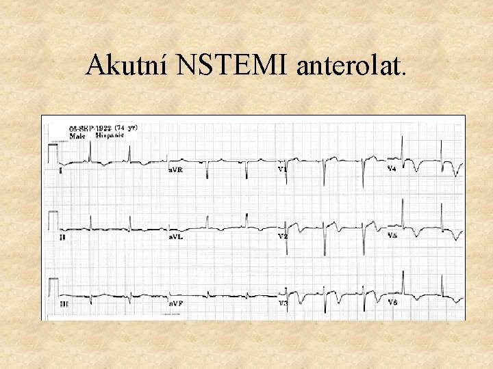 Akutní NSTEMI anterolat. 