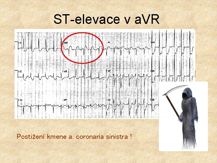 ST-elevace v a. VR Postižení kmene a. coronaria sinistra ! 