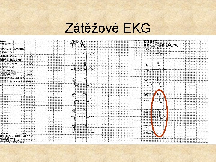 Zátěžové EKG 