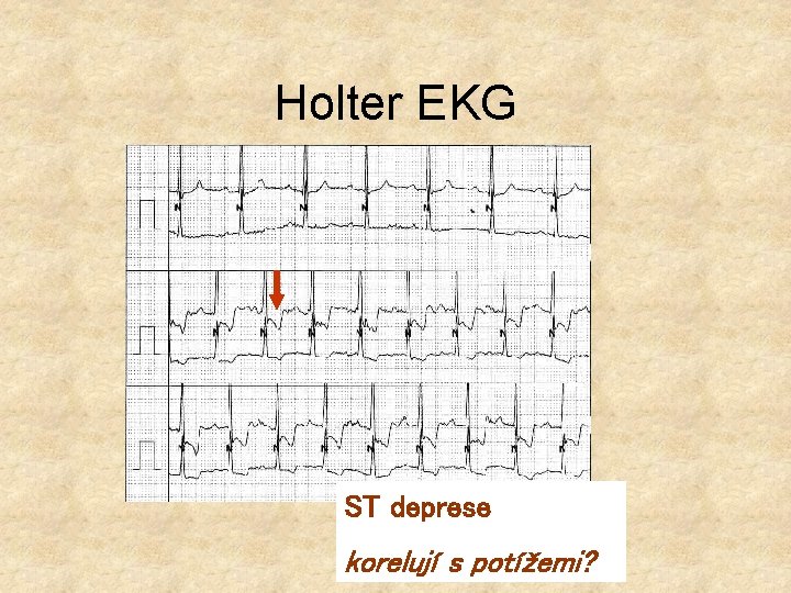 Holter EKG ST deprese korelují s potížemi? 