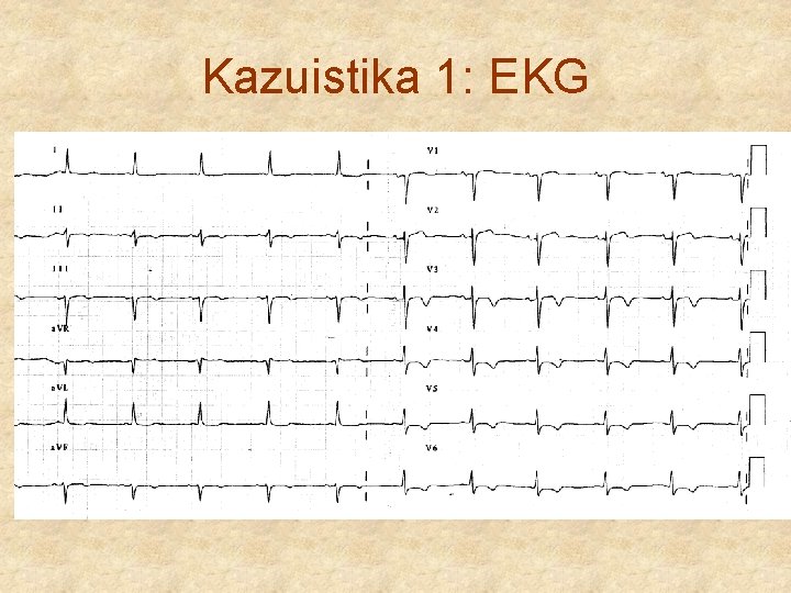 Kazuistika 1: EKG 