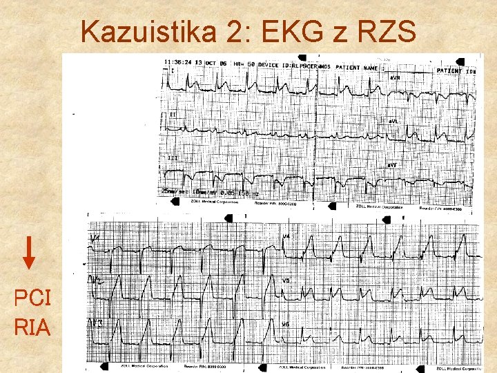 Kazuistika 2: EKG z RZS PCI RIA 