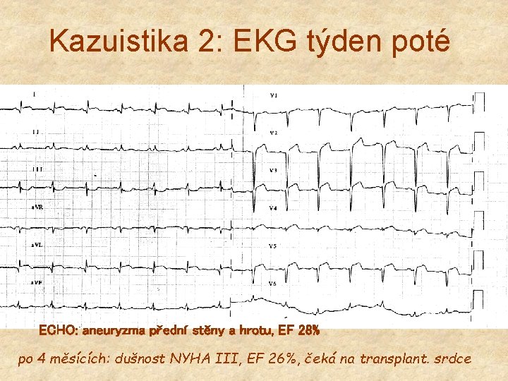 Kazuistika 2: EKG týden poté ECHO: aneuryzma přední stěny a hrotu, EF 28% po