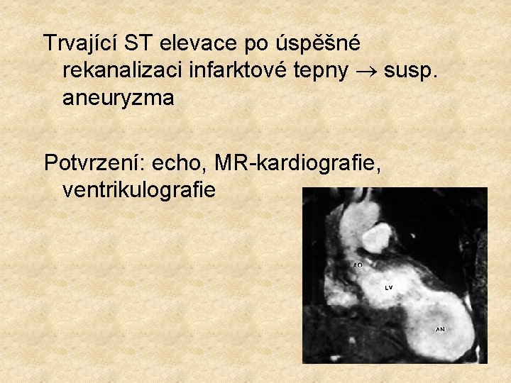 Trvající ST elevace po úspěšné rekanalizaci infarktové tepny susp. aneuryzma Potvrzení: echo, MR-kardiografie, ventrikulografie