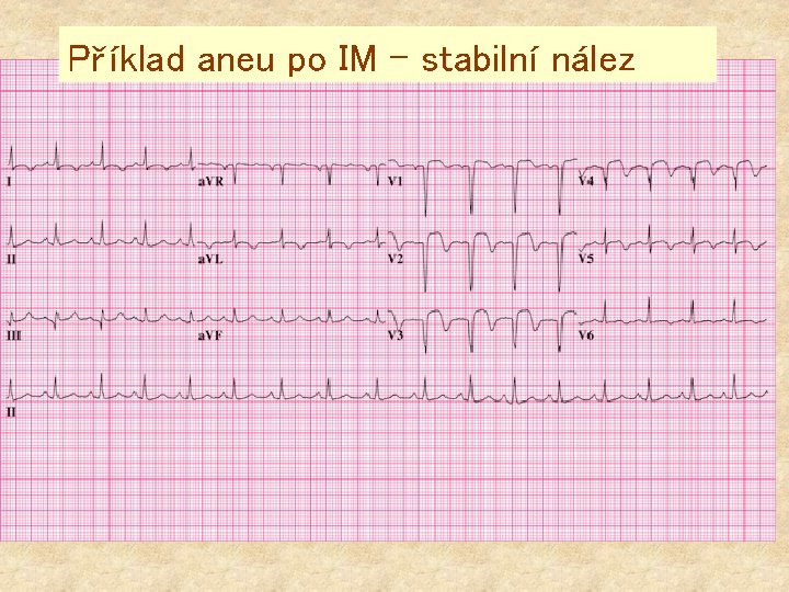 Příklad aneu po IM – stabilní nález 