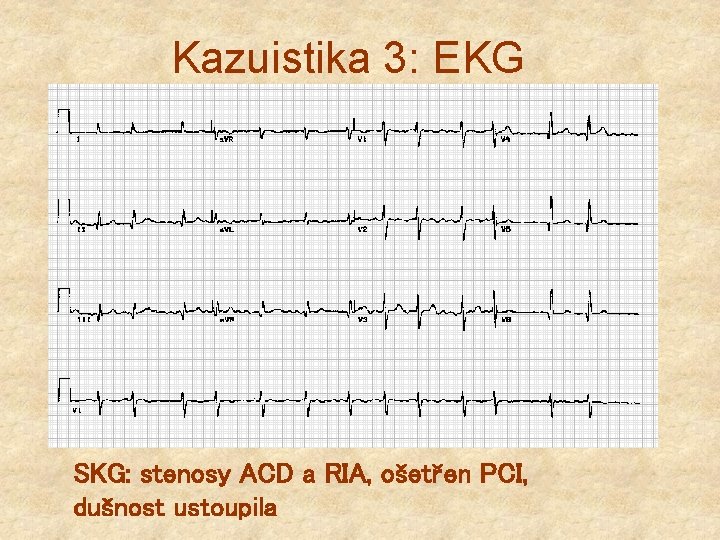 Kazuistika 3: EKG SKG: stenosy ACD a RIA, ošetřen PCI, dušnost ustoupila 