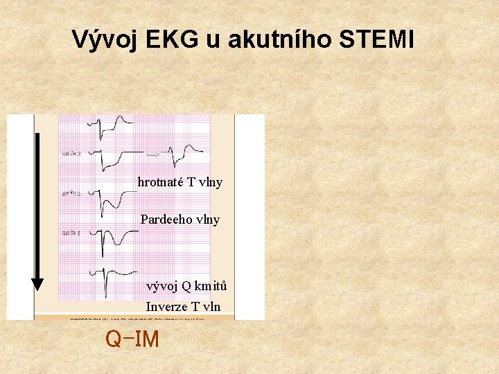 Vývoj EKG u akutního STEMI hrotnaté T vlny Pardeeho vlny vývoj Q kmitů Inverze