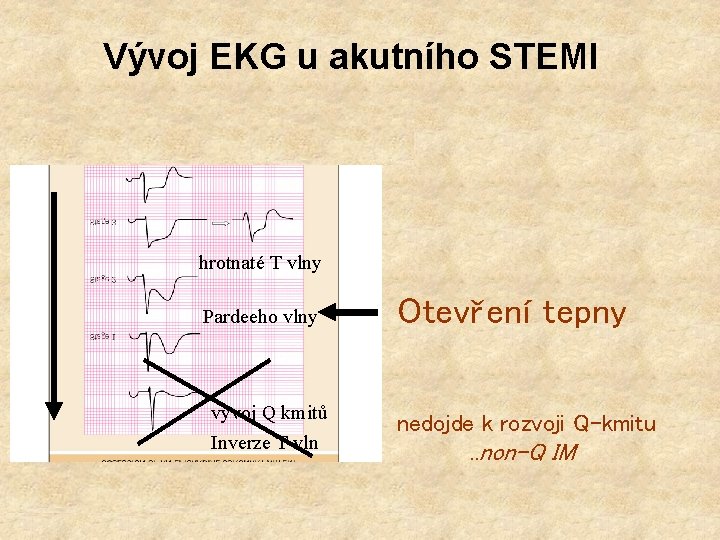 Vývoj EKG u akutního STEMI hrotnaté T vlny Pardeeho vlny vývoj Q kmitů Inverze