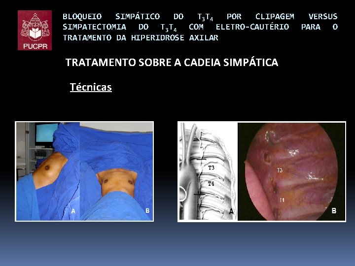 BLOQUEIO SIMPÁTICO DO T 3 T 4 POR CLIPAGEM VERSUS SIMPATECTOMIA DO T 3