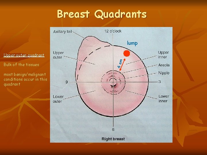 Breast Quadrants lump Bulk of the tissues most benign/malignant conditions occur in this quadrant