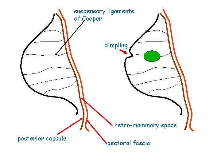 suspensory ligaments of Cooper dimpling retro-mammary space posterior capsule pectoral fascia 