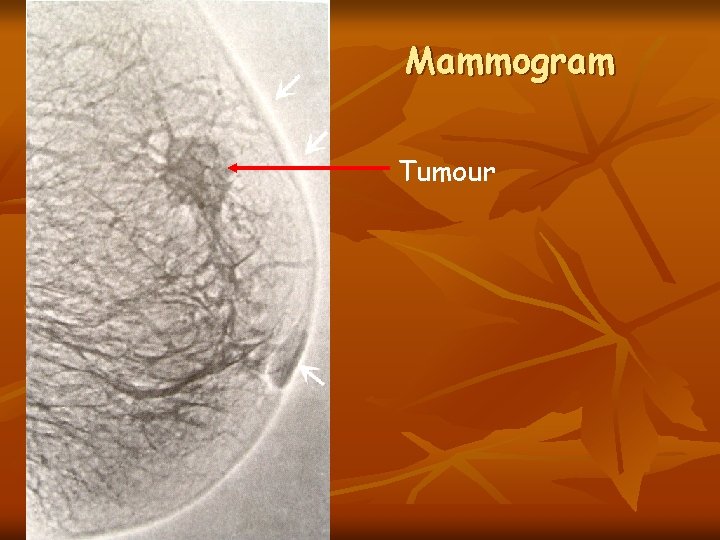 Mammogram Tumour 