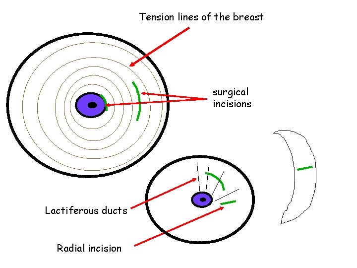 Tension lines of the breast surgical incisions Lactiferous ducts Radial incision 