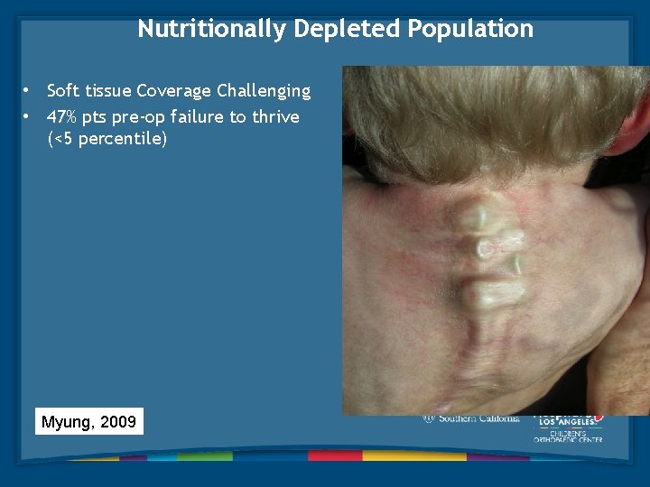 Nutritionally Depleted Population • Soft tissue Coverage Challenging • 47% pts pre-op failure to
