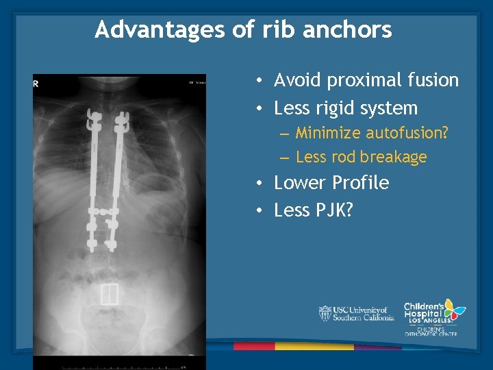 Advantages of rib anchors • Avoid proximal fusion • Less rigid system – Minimize