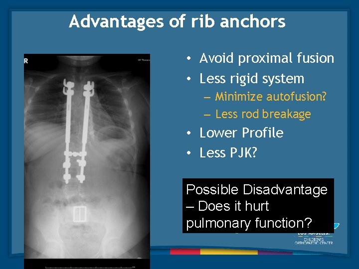 Advantages of rib anchors • Avoid proximal fusion • Less rigid system – Minimize