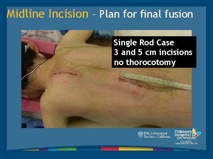 Midline Incision – Plan for final fusion Single Rod Case 3 and 5 cm