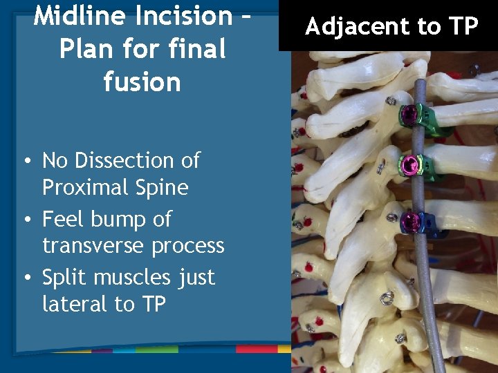 Midline Incision – Plan for final fusion • No Dissection of Proximal Spine •