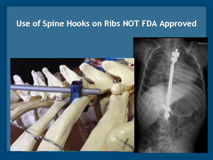 Use of Spine Hooks on Ribs NOT FDA Approved 