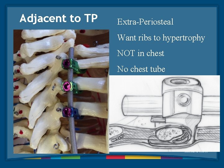 Adjacent to TP Extra-Periosteal Want ribs to hypertrophy NOT in chest No chest tube