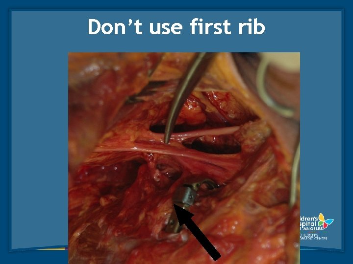 Don’t use first rib 