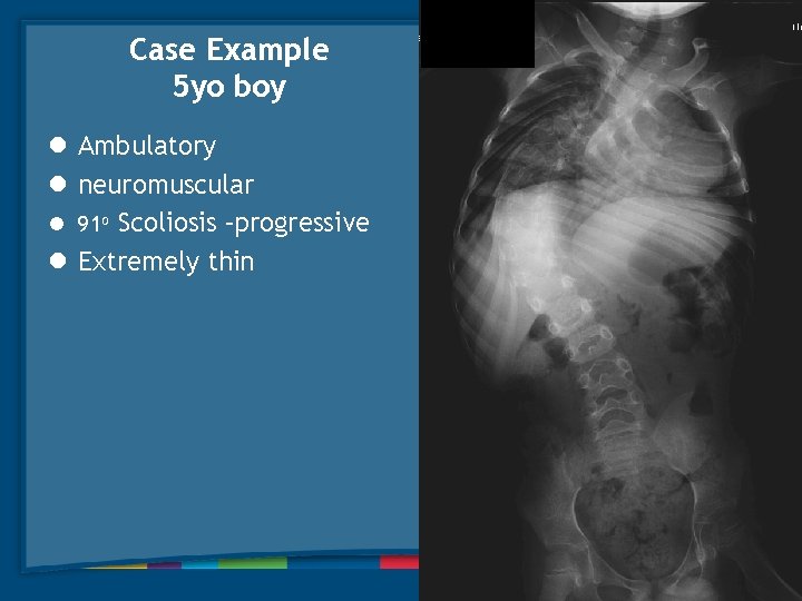 910 Case Example 5 yo boy l Ambulatory l neuromuscular l 91 o Scoliosis