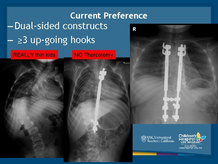 Current Preference – Dual-sided constructs – ≥ 3 up-going hooks REALLY thin kids NO