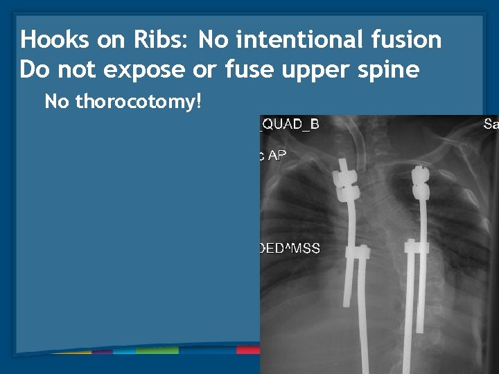 Hooks on Ribs: No intentional fusion Do not expose or fuse upper spine No