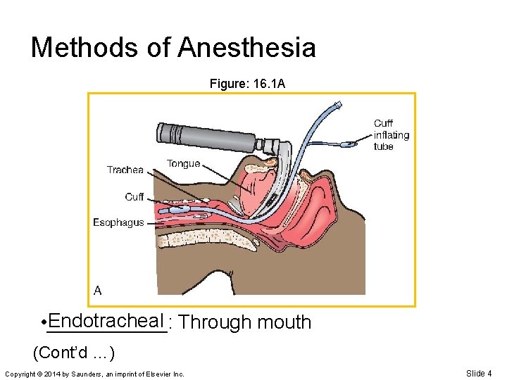 Methods of Anesthesia Figure: 16. 1 A Endotracheal Through mouth • ______: (Cont’d …)