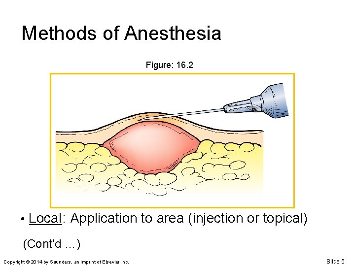 Methods of Anesthesia Figure: 16. 2 • Local _____: Application to area (injection or