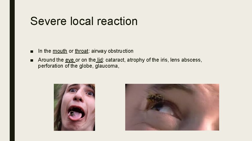 Severe local reaction ■ In the mouth or throat: airway obstruction ■ Around the