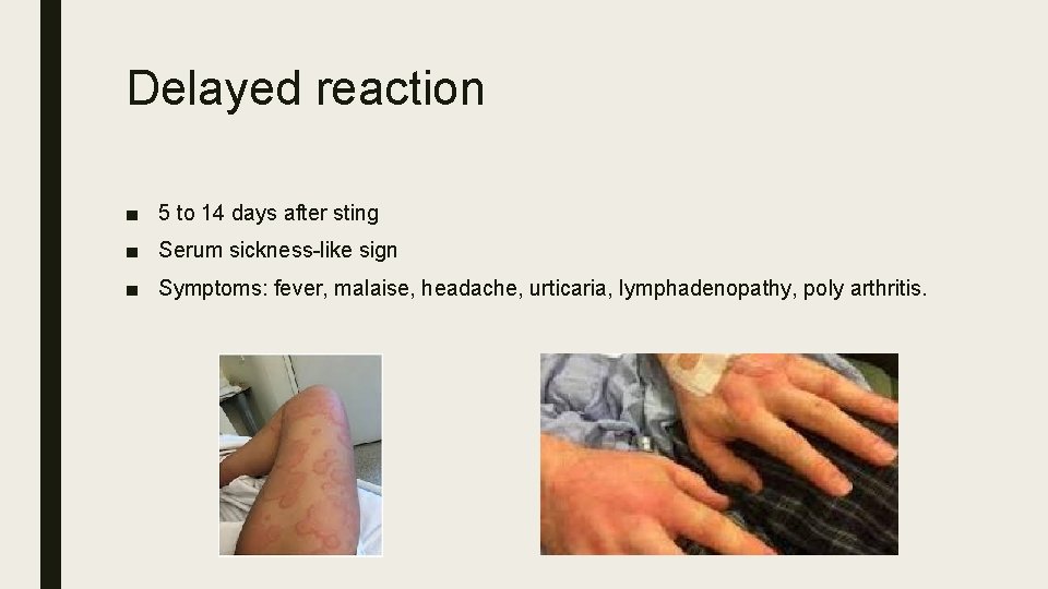 Delayed reaction ■ 5 to 14 days after sting ■ Serum sickness-like sign ■