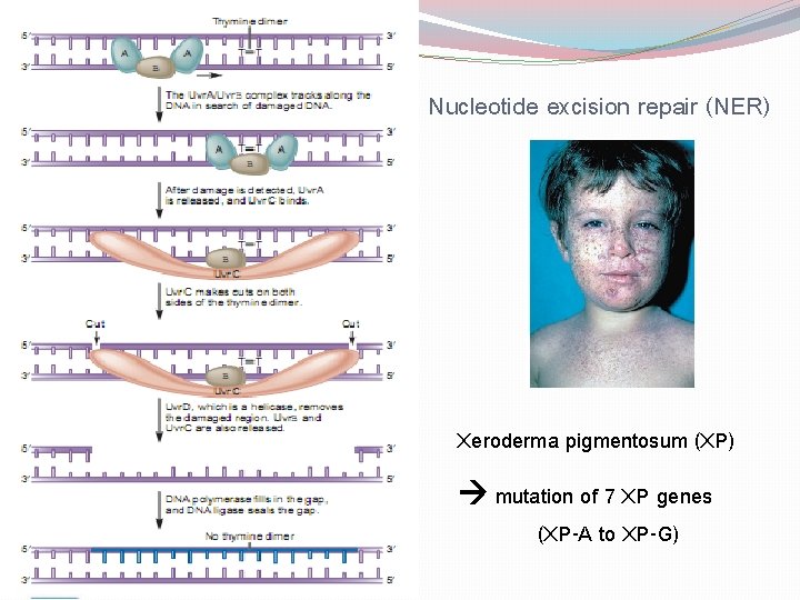 Nucleotide excision repair (NER) Xeroderma pigmentosum (XP) mutation of 7 XP genes (XP-A to