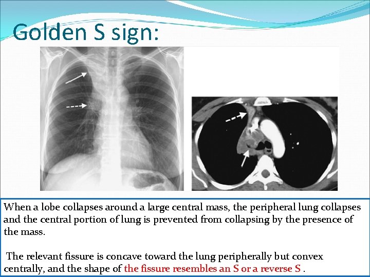 Golden S sign: When a lobe collapses around a large central mass, the peripheral