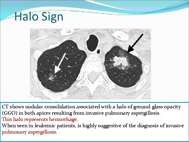 Halo Sign CT shows nodular consolidation associated with a halo of ground-glass opacity (GGO)