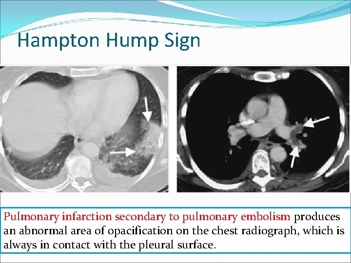 Hampton Hump Sign Pulmonary infarction secondary to pulmonary embolism produces an abnormal area of