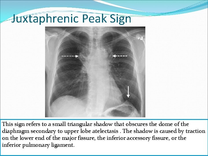 Juxtaphrenic Peak Sign This sign refers to a small triangular shadow that obscures the