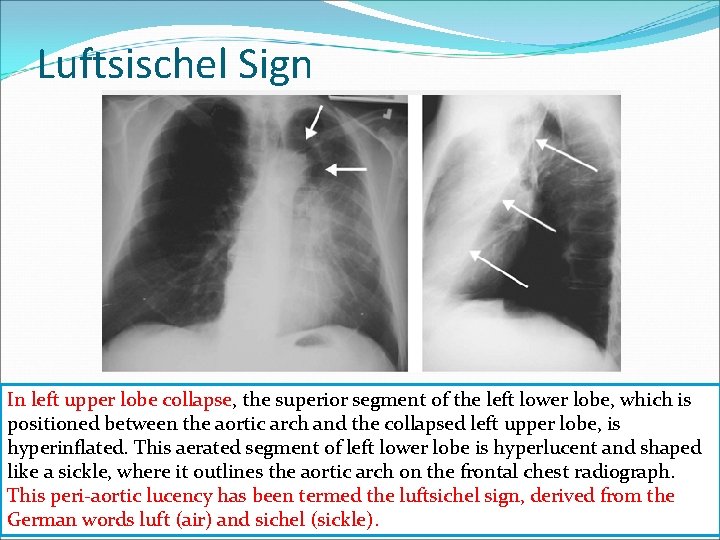 Luftsischel Sign In left upper lobe collapse, the superior segment of the left lower