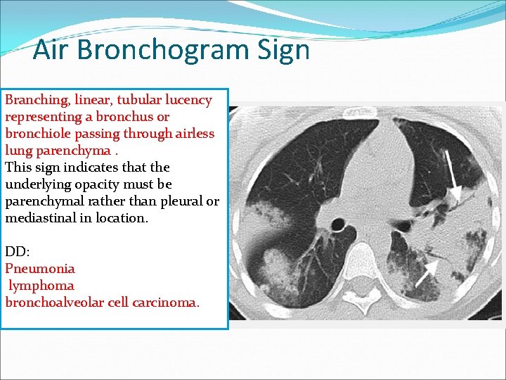 Air Bronchogram Sign Branching, linear, tubular lucency representing a bronchus or bronchiole passing through