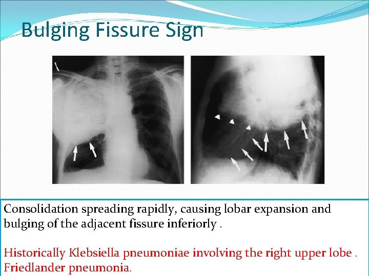 Bulging Fissure Sign Consolidation spreading rapidly, causing lobar expansion and bulging of the adjacent