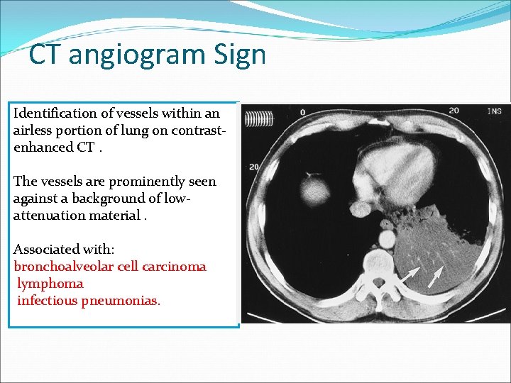 CT angiogram Sign Identification of vessels within an airless portion of lung on contrastenhanced