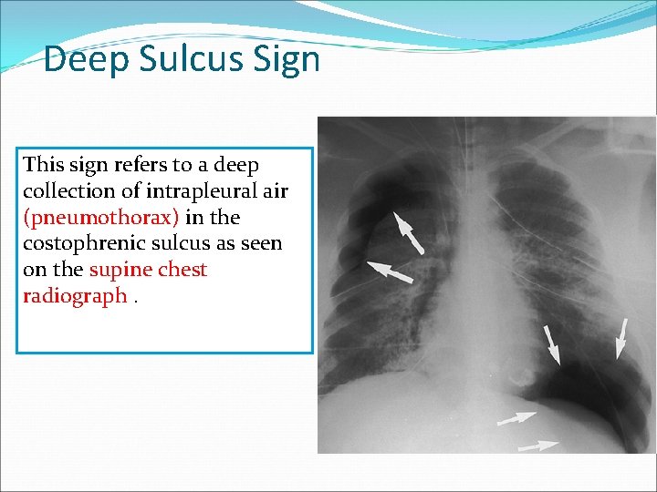 Deep Sulcus Sign This sign refers to a deep collection of intrapleural air (pneumothorax)