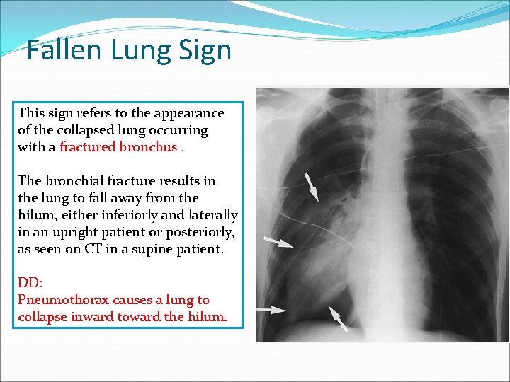 Fallen Lung Sign This sign refers to the appearance of the collapsed lung occurring