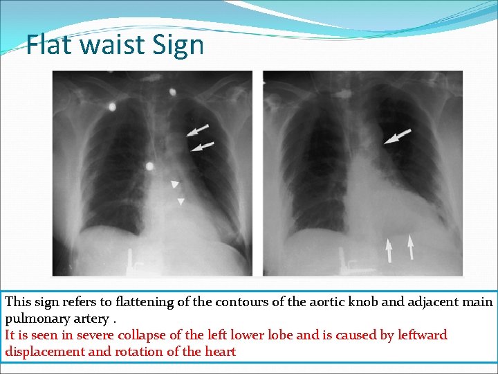 Flat waist Sign This sign refers to flattening of the contours of the aortic