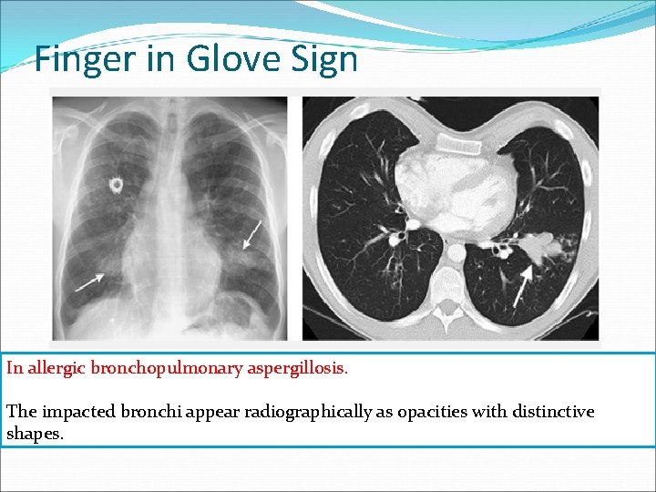 Finger in Glove Sign In allergic bronchopulmonary aspergillosis. The impacted bronchi appear radiographically as