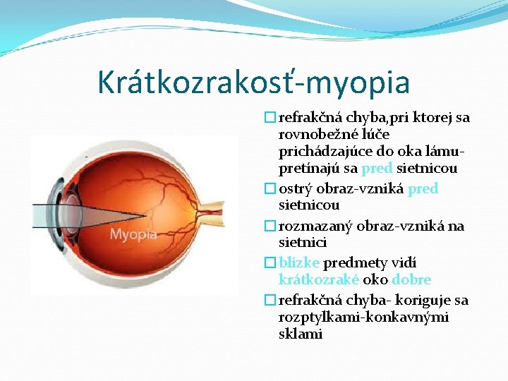 Krátkozrakosť-myopia �refrakčná chyba, pri ktorej sa rovnobežné lúče prichádzajúce do oka lámupretínajú sa pred