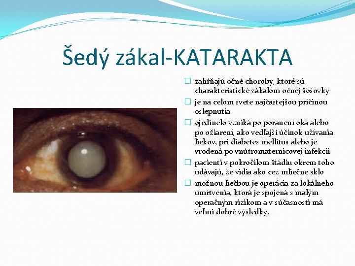 Šedý zákal-KATARAKTA � zahŕňajú očné choroby, ktoré sú charakteristické zákalom očnej šošovky � je