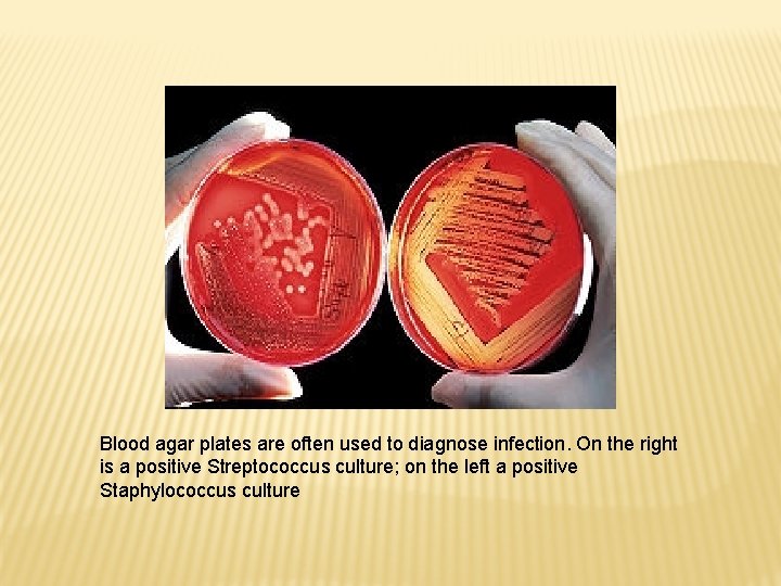 Blood agar plates are often used to diagnose infection. On the right is a