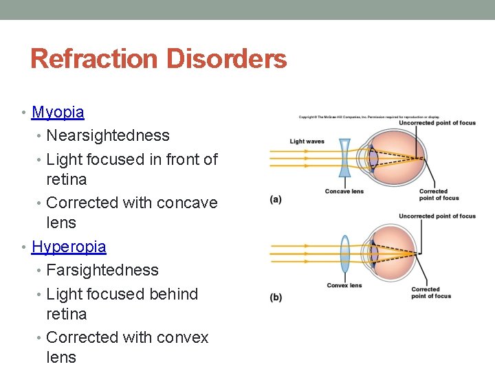 Refraction Disorders • Myopia • Nearsightedness • Light focused in front of retina •